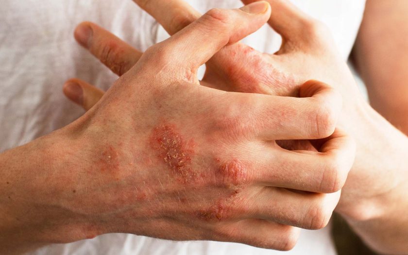 eczema